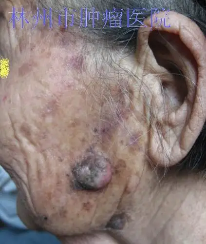 面部早期皮肤癌图片