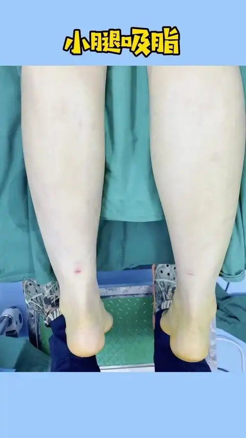 小腿单侧刚做完的效果