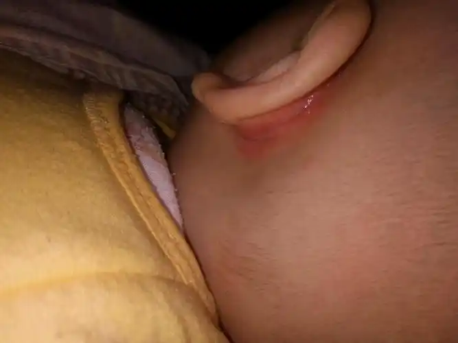 宝宝长割耳疮怎么办