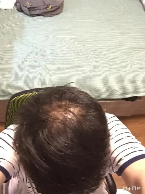 15岁头发光成这样是秃头了吗