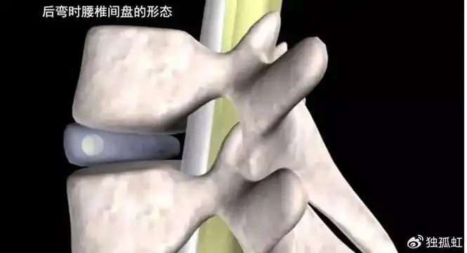 腰椎间盘突出千万不能做这个动作|仰卧起坐|腰椎|腰椎间盘突出_新浪新