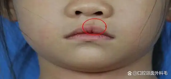 宝宝患有唇腭裂,该怪谁?