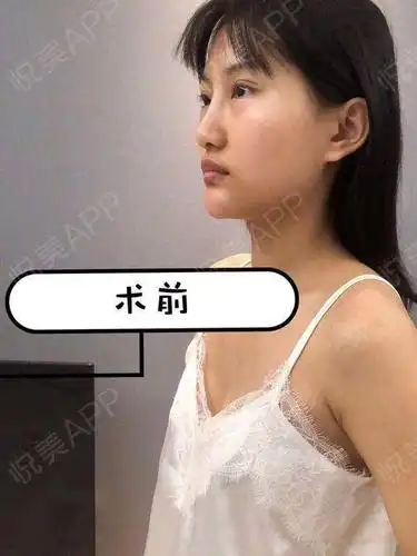 自体脂肪丰胸适合所有人做术后多久才能穿内衣