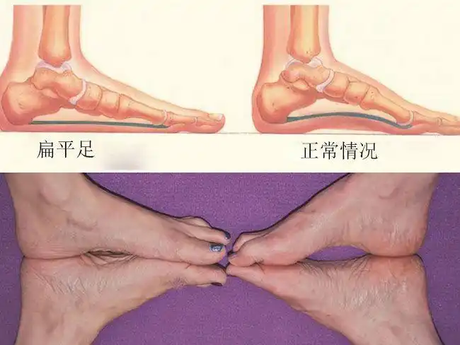 脚后跟疼痛的原因,长期贴膏药却不好用,教你怎么解决|扁平足|肌肉