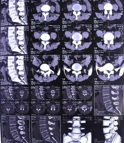 椎间孔镜技术治疗腰椎间盘突出症一例