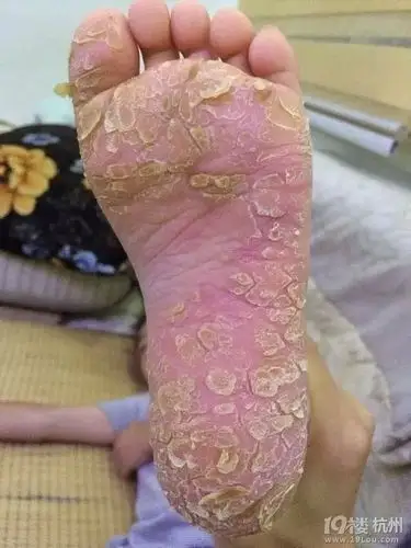 8岁留守儿童手脚皲裂请求大家帮助早日回到学校