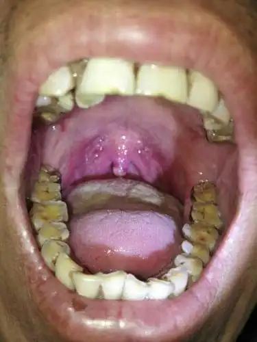 求救 求救求救 懂的医师 专家 麻烦耽误几分钟给我看一下 开始悬雍垂