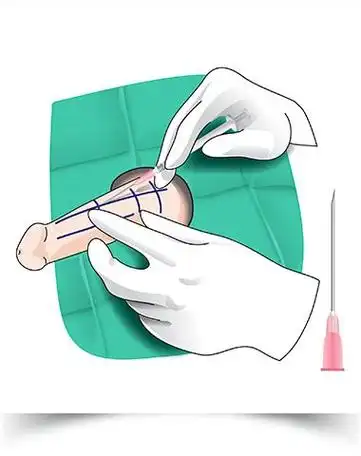 玻尿酸注射阴茎增粗手术怎么做效果如何