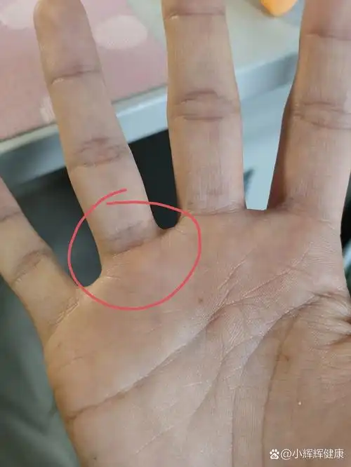 手指关节处有个像骨头一样的肿物,有点疼