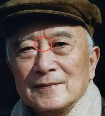 动脉硬化我们把它称为"鼻褶心征"因为这种横纹建议警惕心血管方面的