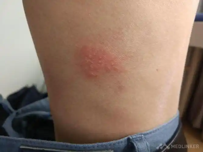 单纯疱疹病毒感染