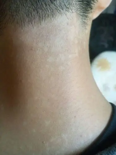 在皮肤科门诊常有些病患,以为由汗水所引起的所有皮疹,都叫汗斑,其实