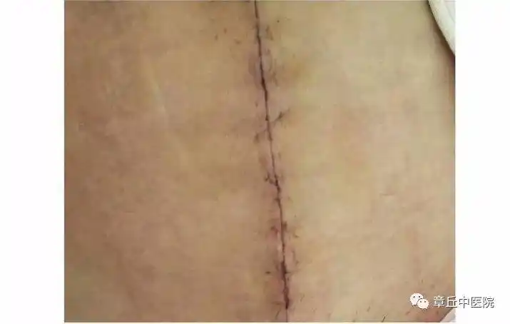 为产妇在进行美容缝合术之前的腹部外观,有约10厘米纵行陈旧行伤口