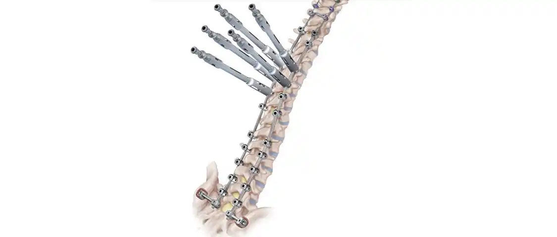 expedium5.5胸腰椎后路矫形钉棒