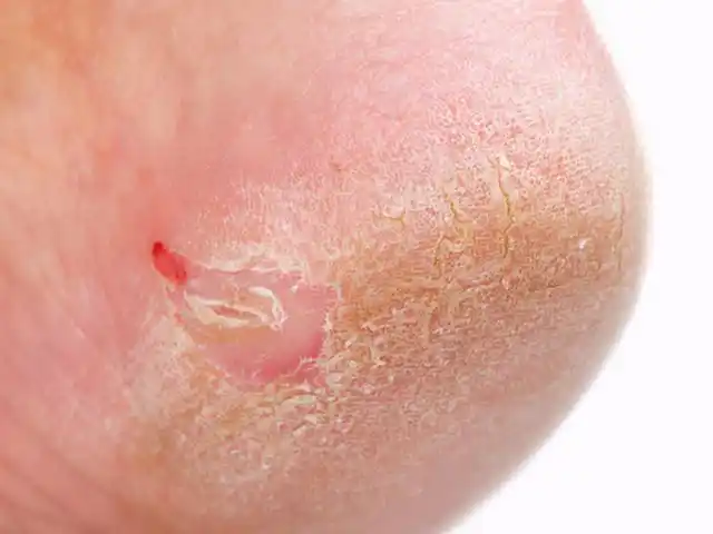 双脚是肝脏健康的"晴雨表",连续出现这3种异常,肝病来袭