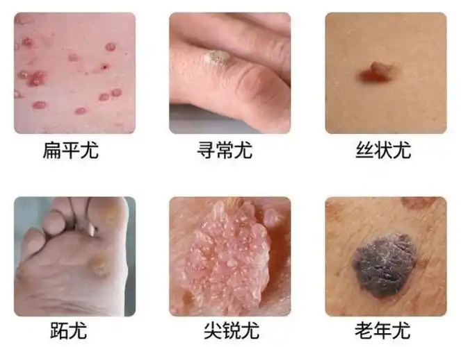 要注意的是,跖疣是会传染的!