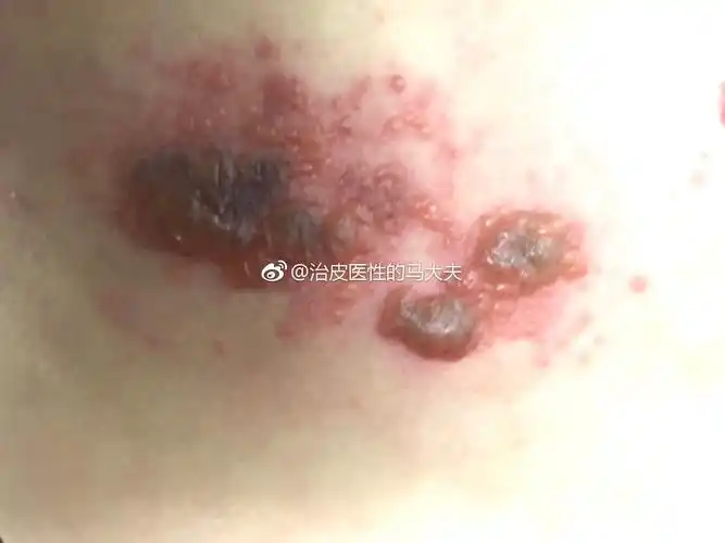 疱疹痛怎么预防 - 好大夫在线