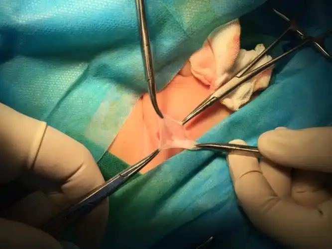 小儿疝气手术开刀不用缝合