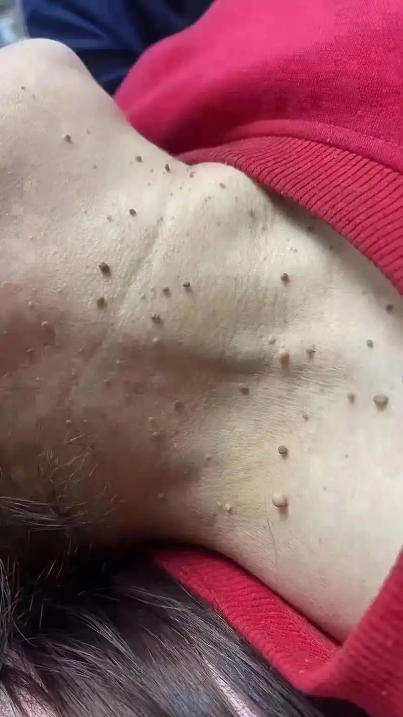 "疣,疣,疣" 有两个洋气的名字①中文名:人类乳头瘤病 - 抖音