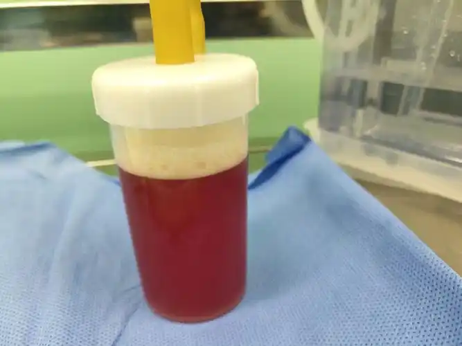 恶性胸水的克星——内科胸腔镜诊治胸腔积液新技术. - 美篇