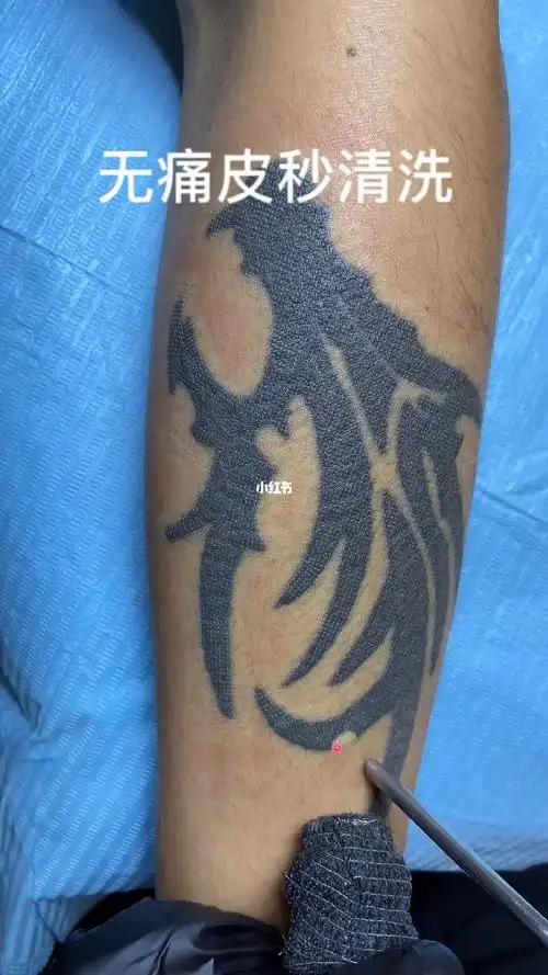 无痛皮秒洗纹身