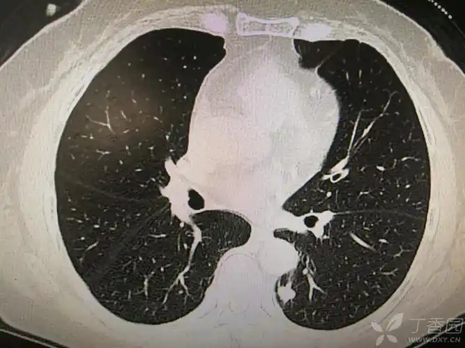据影识病:双下肺分布的分叶状结节,肿瘤?结核?炎症? [病例帖]