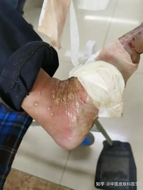 每天分享一例典型病例—类天疱疮 - 知乎