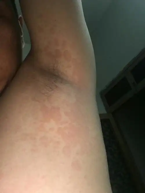 腋窝里长汗斑花斑癣,腋窝汗斑好根治吗?