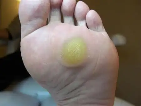 瘊子和疣的区别图片(脚上长的是鸡眼) - 赤虎壹号