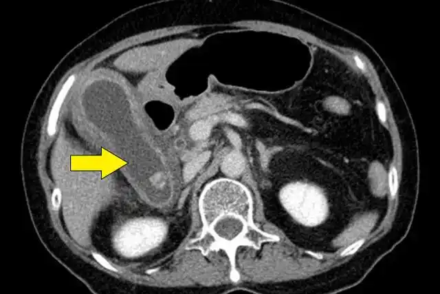 ct 扫描提示胆囊扩张(箭头),胆囊壁增厚,胆汁淤积,胆囊周围炎症(图片
