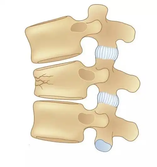 阿耀科普|胸腰椎压缩性骨折_胸腰椎骨折_介绍_检查_治疗方式_康复锻炼