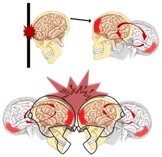 头撞得好痛不会脑震荡了吧