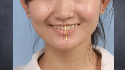 成人中线不正矫正案例 (原创)