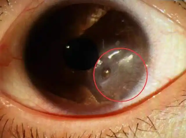 左眼靠近瞳孔处有一处角膜穿孔