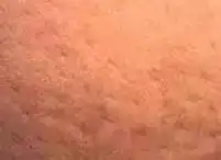 九个早期乳腺癌的迹象