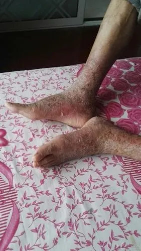 82岁老人的皮肤病,求治疗方法