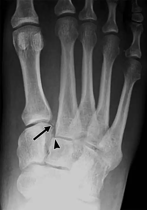 "骨裂"跟"骨折"一样么?听听骨科专家怎么说!