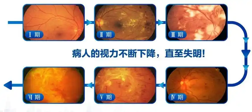 糖友们会问了:"糖尿病怎么会和眼睛扯上关系?会有什么并发症?