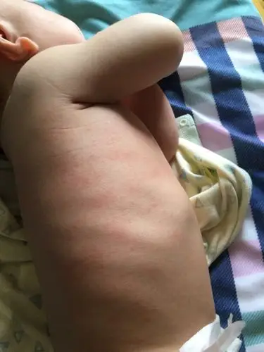 求帮助,宝宝起的湿疹还是痱子