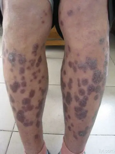 梅毒图片_梅毒症状表现图片大全_有来医生