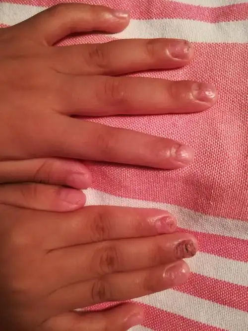 小儿指甲凹凸不平求诊治