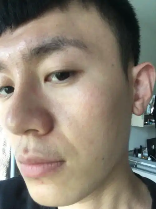 24岁,皮肤松弛老化严重,毛孔粗大,做什么项目可以有效解决