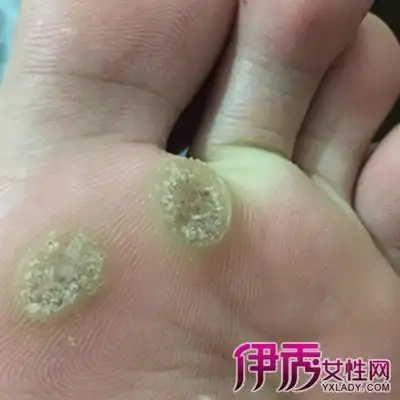 【图】展示病毒疣图片 教您如何治疗病毒疣