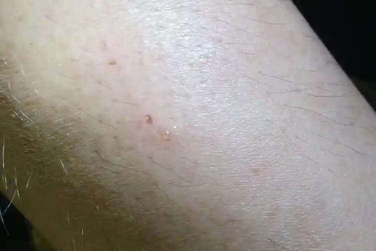 无毒蜘蛛咬的伤口