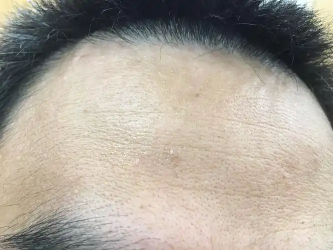 请问脑门上这些凸起是扁平疣么?谢谢