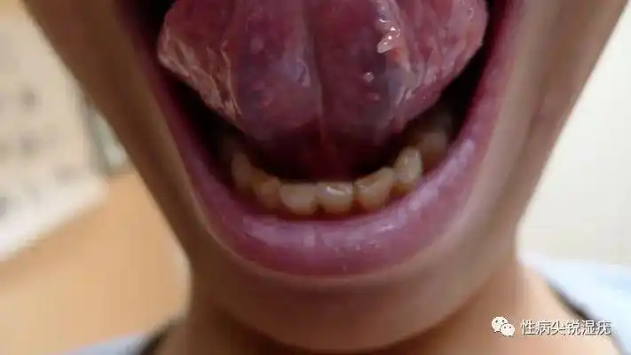 请问这是口腔尖锐湿疣