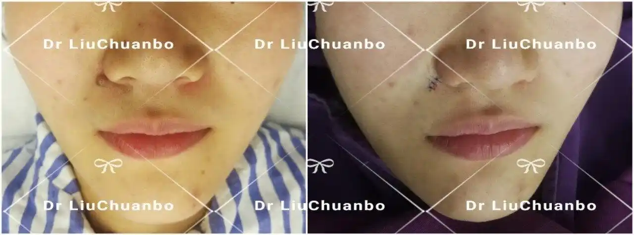 面部皮肤肿物手术方式选择_体表肿瘤_体表肿瘤相关疾病 - 好大夫在线