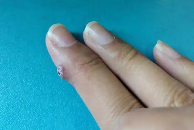 手上肉芽肿图片