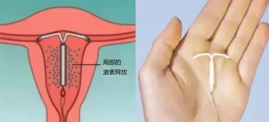 慈海医疗||女性朋友的福音——神奇的曼月乐环_子宫