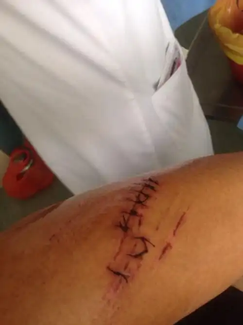 受了工伤手臂缝了30针应该可以赔偿多少钱,没有签合同,没有伤到骨和筋